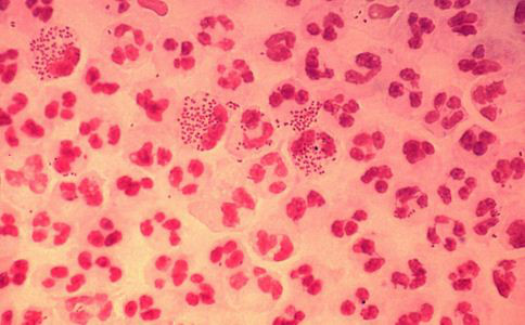 艾滋病病毒株流行趋势 这么做能防止艾滋 艾滋病病毒株流行趋势 如何预防艾滋病 艾滋病的预防方法